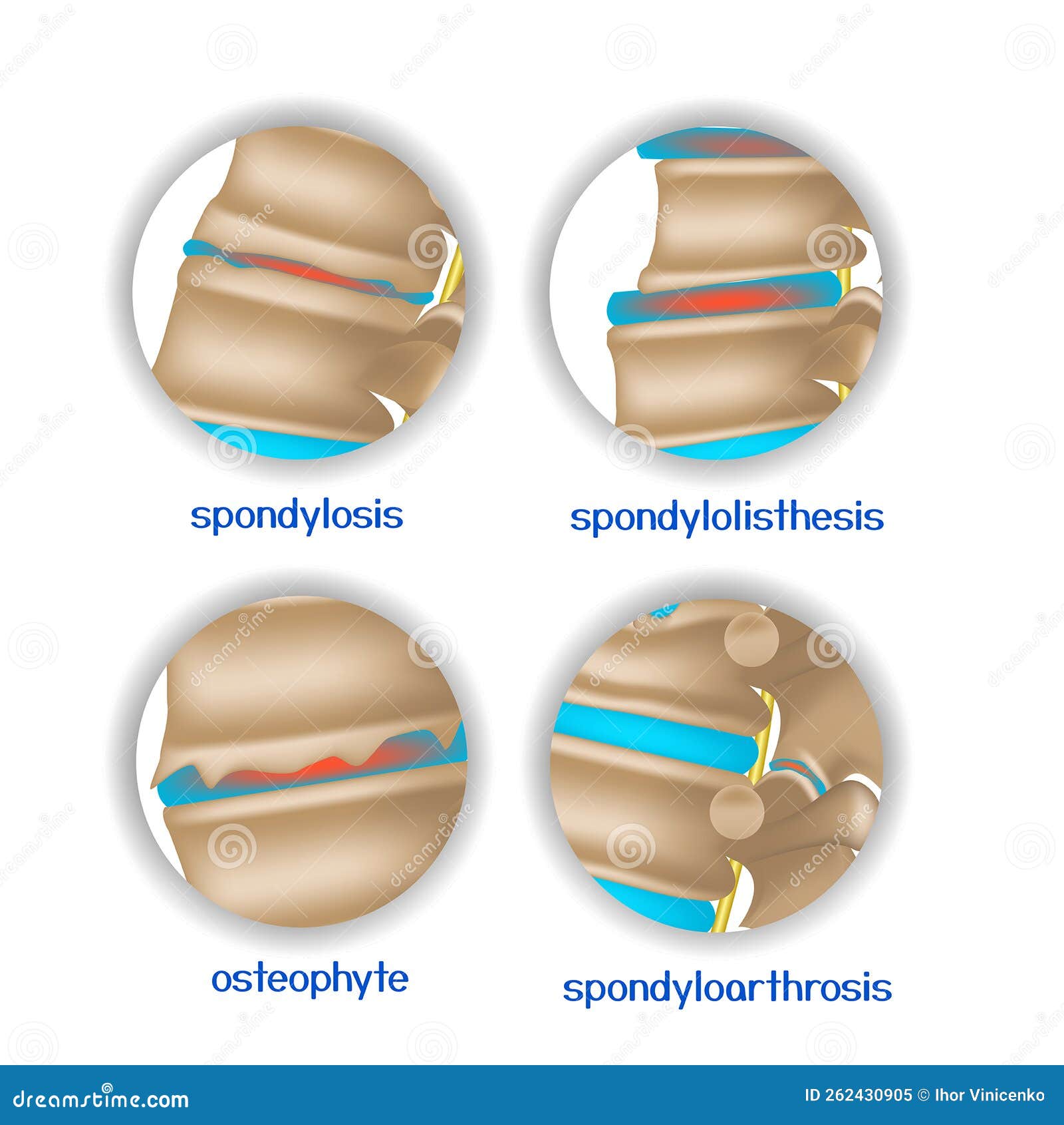 spine diseases. various pathologies of intervertebral discs and bones.